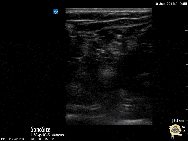 Soft Tissue - Sciatic Nerve