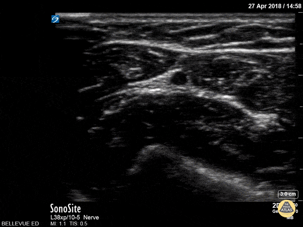Nerve Block Gallery - Ulnar Nerve (Copy)