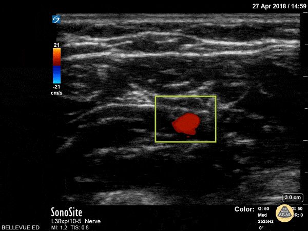 Nerve Block Gallery - Ulnar Nerve and Artery