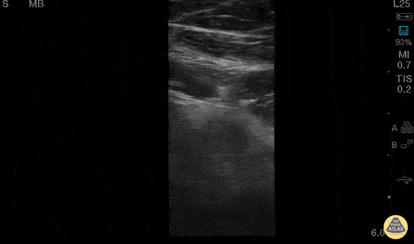 Bowel-GI - Appendicitis Transverse