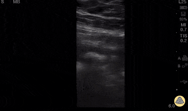 Bowel-GI - Appendicitis Longitudinal