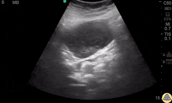 Bowel-GI - GI Tumor - GIST