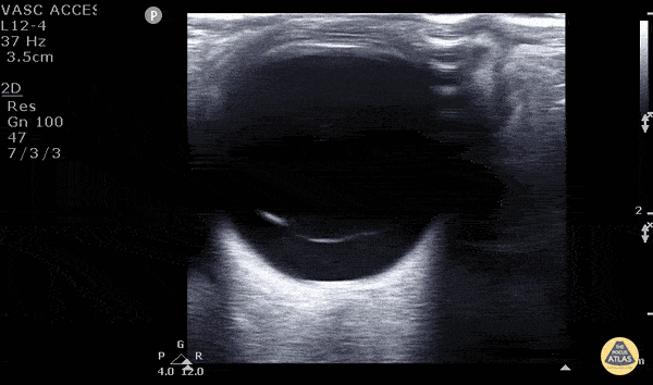 Orbital - Vitreous Detachment