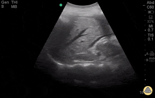OB/Gyn - Ruptured Ectopic With Positive Fast
