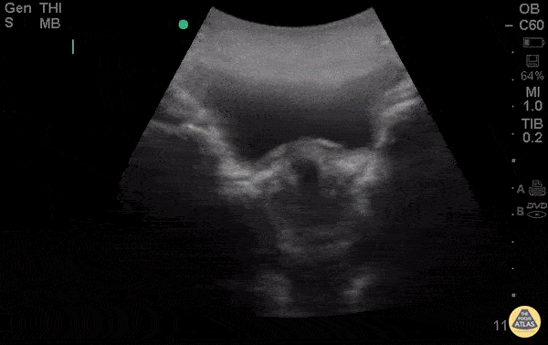 OB/Gyn - Spontaneous Abortion