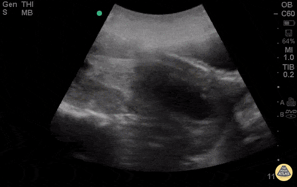 OB/Gyn - Spontaneous Abortion Sagittal