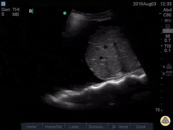 Pulmonary - Spine Sign