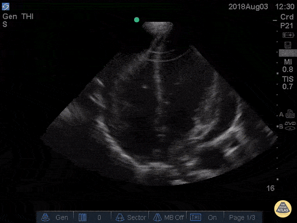 Pericardial Disease - Cardiac Tamponade Apical Four