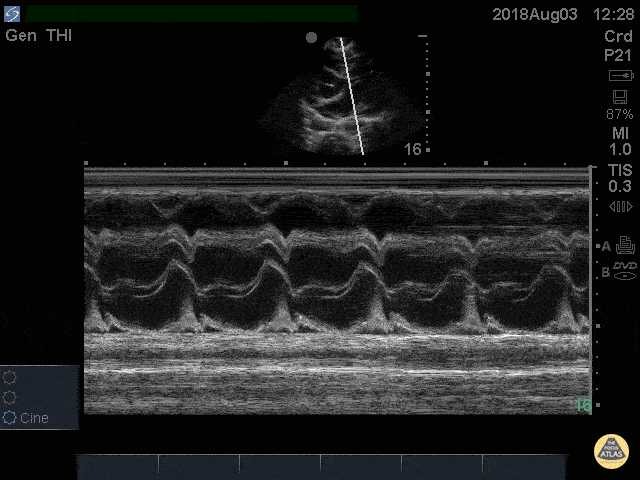 Pericardial Disease - Cardiac Tamponade RV Diastolic Collapse M-mode