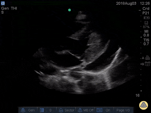 Pericardial Disease - Cardiac Tamponade Parasternal Long