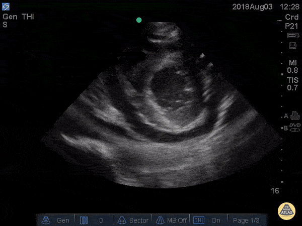 Pericardial Disease - Cardiac Tamponade Parasternal Short