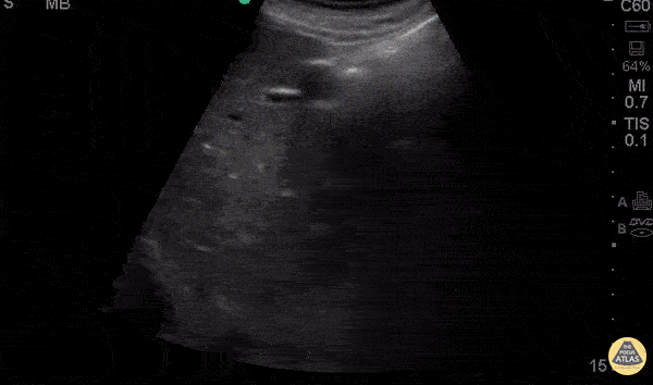 Peds-Gastrointestinal - Splenic Sequestration