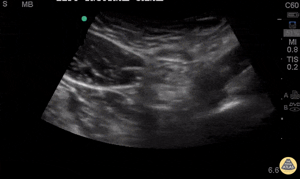 Bowel-GI - Inguinal Hernia With Peristalsis