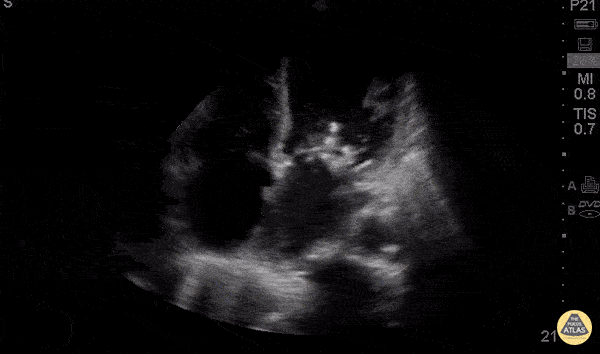 Valvulopathy - Mitral Vegetations