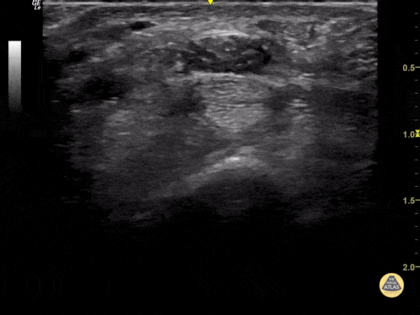 Nerve Block Gallery - Median Nerve Injection