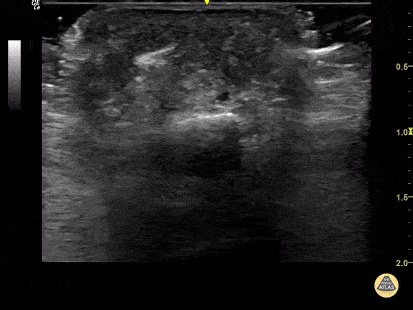 Soft Tissue - Foreign Body Flexor Tendon Sheath
