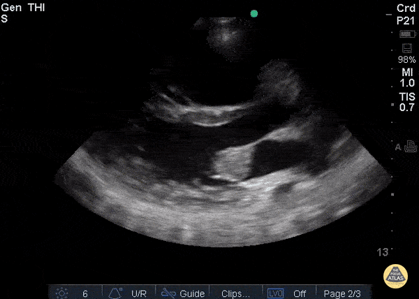 Valvulopathy - Endocarditis PLAX