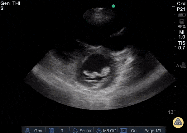 Valvulopathy - Endocarditis PSAX