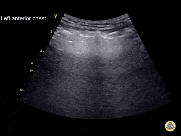Pulmonary - Subcutaneous Emphysema