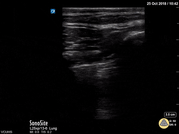 Pulmonary - Lung Point