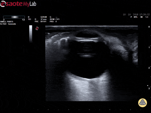 Orbital - Subcutaneous Emphysema - Eyelid