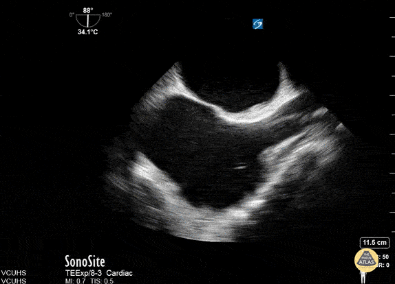 Other Cardiac Pathology - TEE - ECMO Placement Confirmation