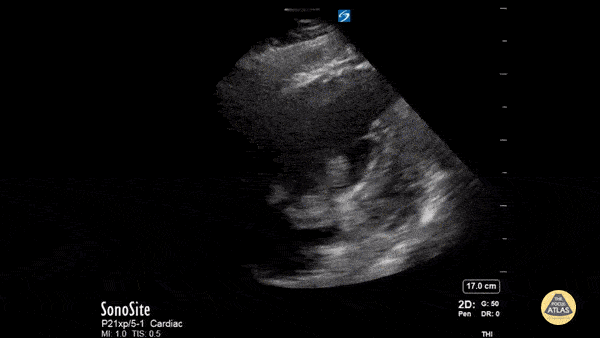 Right Ventricular Dysfunction - McConnell's Sign