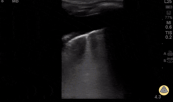 Pediatrics - Pneumonia