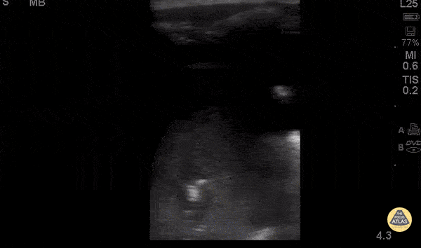 Pediatrics - Pneumonia