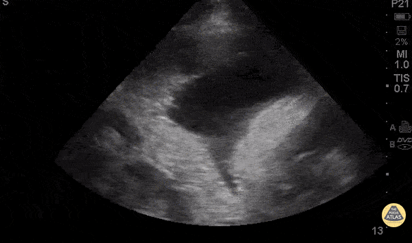 Pulmonary - Malignant Effusion