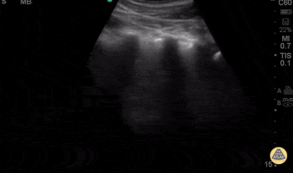 Pediatrics - Focal B-lines - Pneumonia