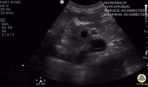 Aorta - Aortic Dissection