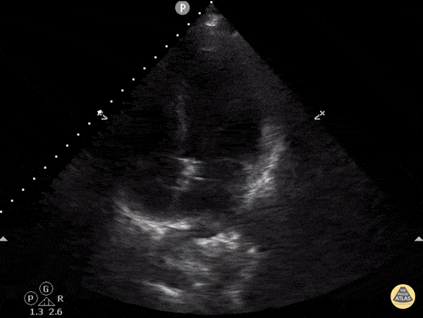 Left Ventricular Dysfunction - Reverse Takotsubo Cardiomyopathy
