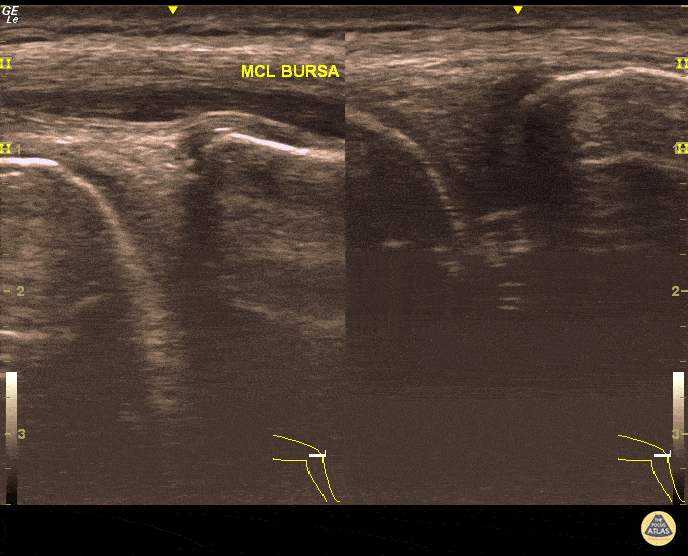 Musculoskeletal - MCL Bursitis