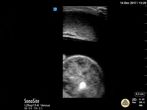 Bowel-GI - Strangulated Inguinal Hernia