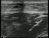 Soft Tissue - Compression for Abscess Identification