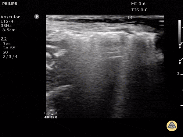 Soft Tissue - Subcutaneous Emphysema