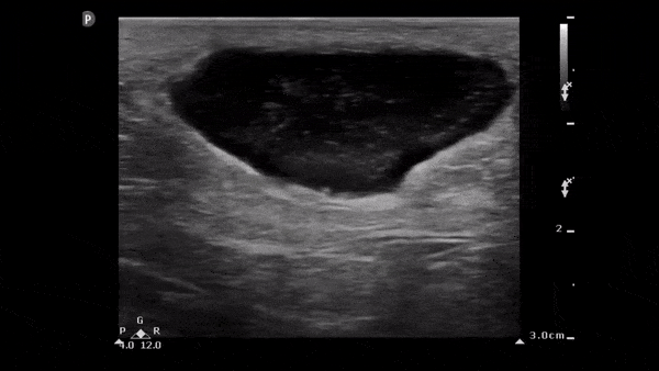 Soft Tissue - Soft Tissue Abscess