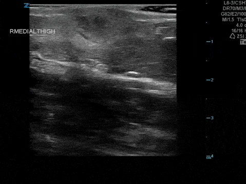 Soft Tissue - Atypical Abscess