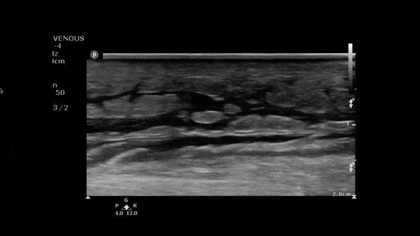 Soft Tissue - Cobblestoning in Cellulitis