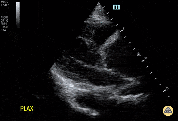 Thoracic Aortic Dissection & Aneurysm - Aortic Root Dilation Due to Aortic Dissection
