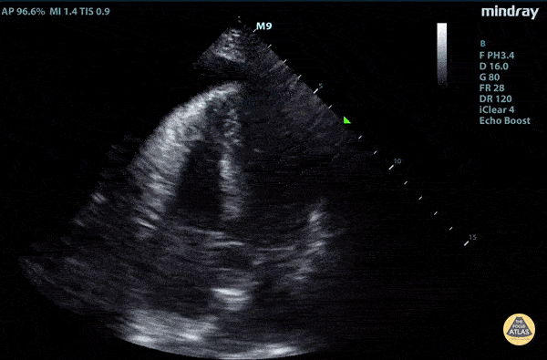 Thoracic Aortic Dissection & Aneurysm - Aortic Dissection Causing Cardiac Tamponade