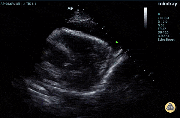 Pericardial Disease - Parasternal Long Type A Aortic Dissection with Tamponade