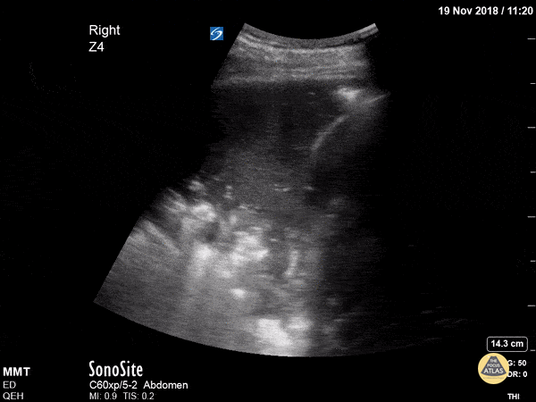 Pulmonary - Dynamic Air Bronchograms in Pneumonia