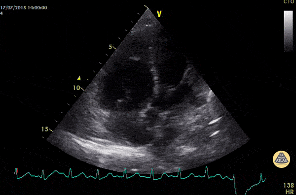Right Ventricular Dysfunction - Acute PE with McConnell's Sign
