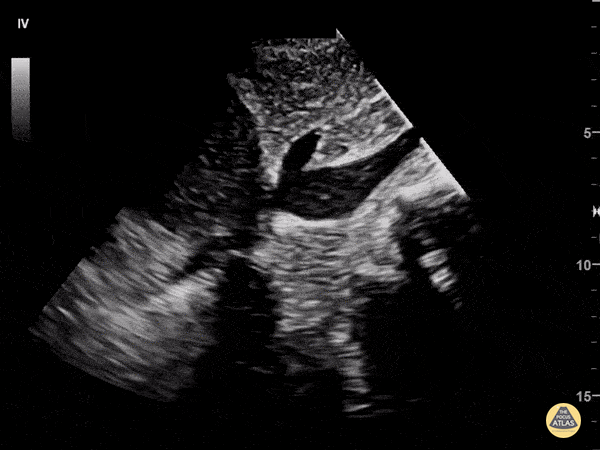 IVC & Abnormal Venous Waveforms - Look at the IVC in Cardiac Tamponade