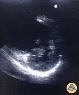 Right Ventricular Dysfunction - The D-Sign in Acute PE