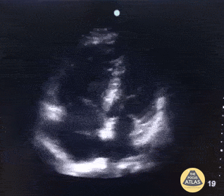 Right Ventricular Dysfunction - Right Atrial Thrombus