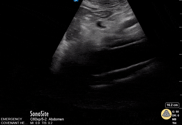 Aorta - Thoracic Aortic Dissection