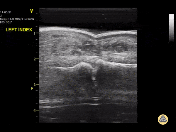 Musculoskeletal - DIPJ Abscess